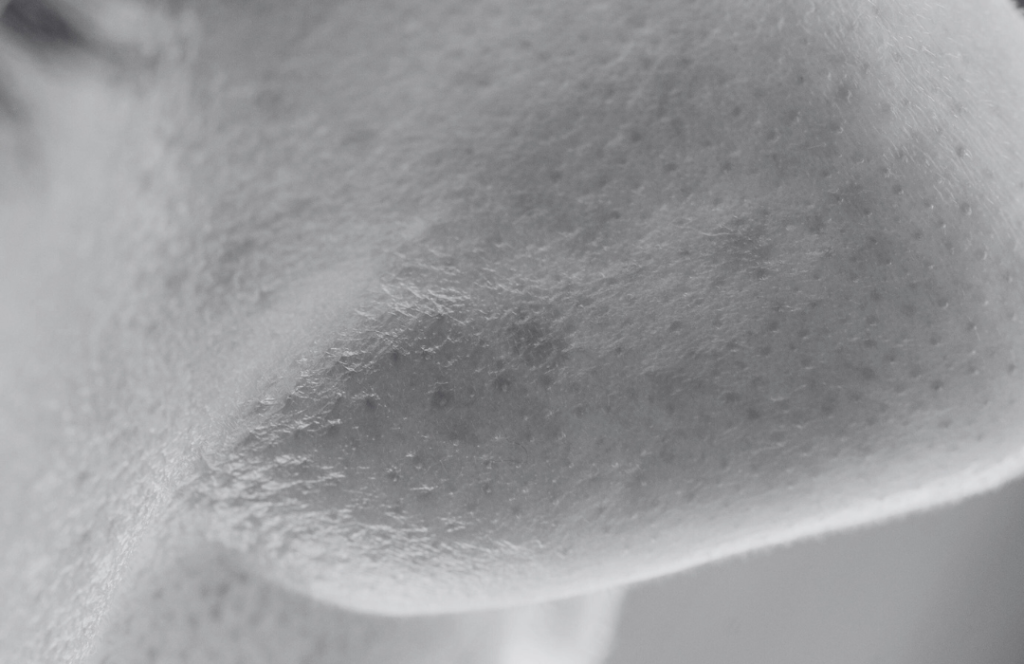 Close-up of skin showing enlarged pores on the nose and cheeks