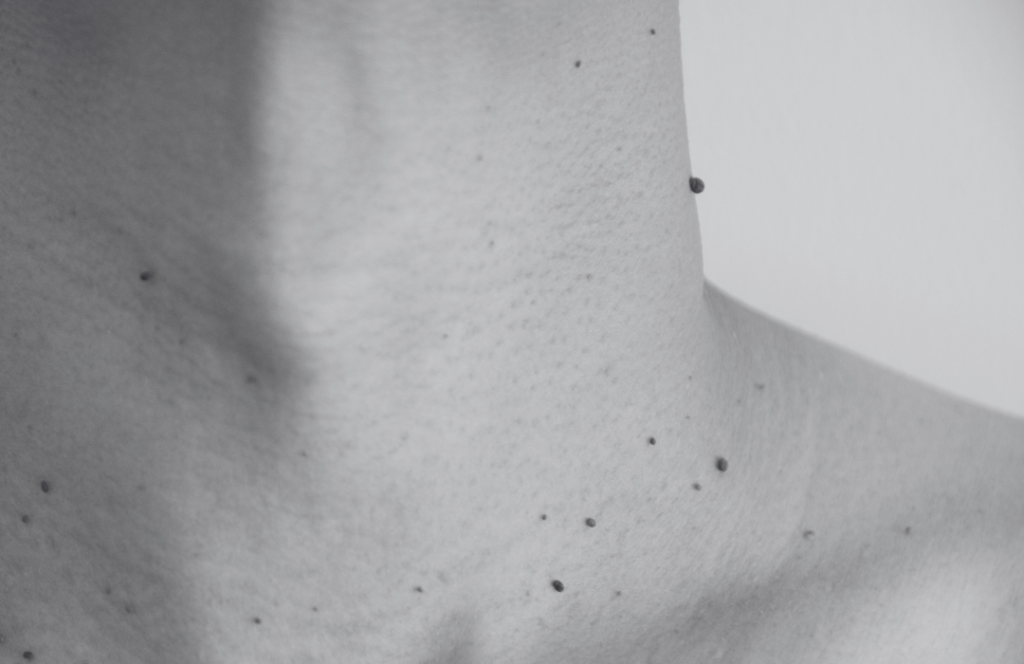 Close-up of skin showing a skin tag or cherry angioma