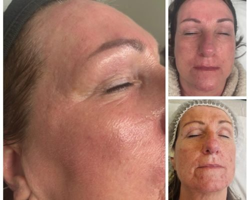 Amanda's skin transformation before and after microneedling treatment at AC Nurse Aesthetics in Morley, Leeds — showing improved skin texture and tone